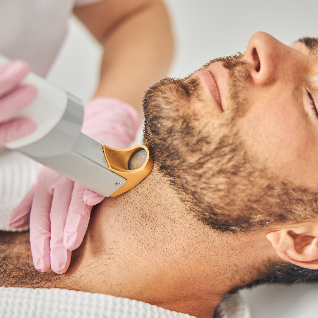Man receiving laser facial hair removal on beard